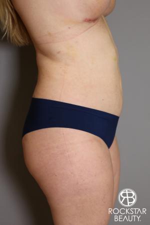 Liposuction: Patient 11 - After Image 3