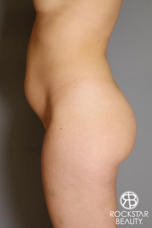 Brazilian Butt Lift: Patient 18 - Before Image 2