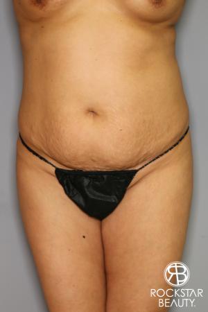 Brazilian Butt Lift: Patient 12 - Before Image 2