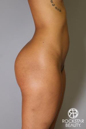 Brazilian Butt Lift: Patient 8 - Before Image 2