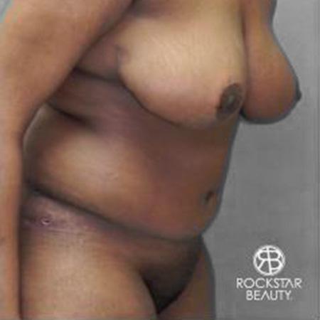 Tummy Tuck: Patient 9 - After 3
