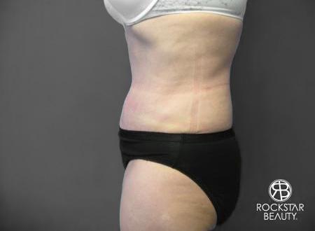 Tummy Tuck: Patient 6 - After 4