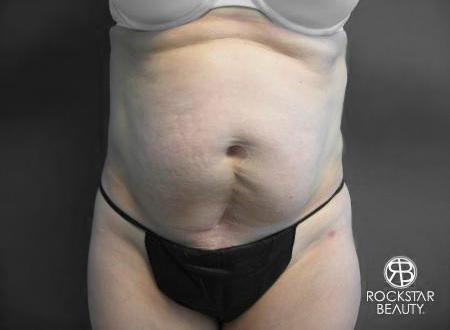 Tummy Tuck: Patient 6 - Before 1