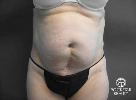 Tummy Tuck: Patient 6 - Before Image 1