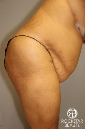 Tummy Tuck: Patient 3 - Before and After Image 4