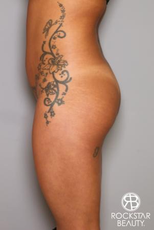 Brazilian Butt Lift: Patient 9 - Before Image 3