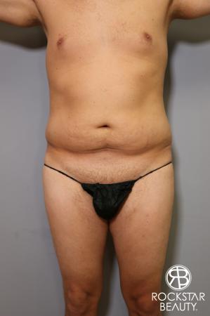 Tummy Tuck: Patient 5 - Before Image 2