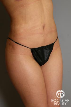 Liposuction: Patient 14 - After Image 3