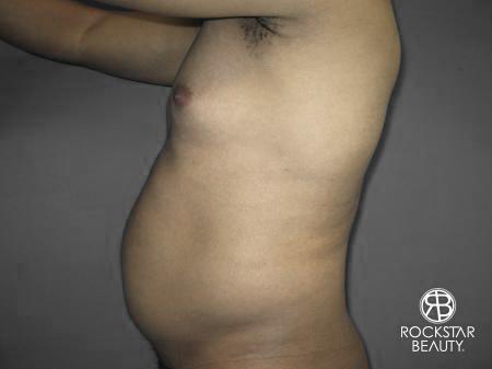 Liposuction: Patient 10 - Before and After 5