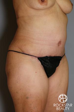 Tummy Tuck: Patient 13 - After Image 2