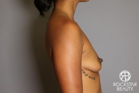Breast Augmentation: Patient 14 - Before Image 4