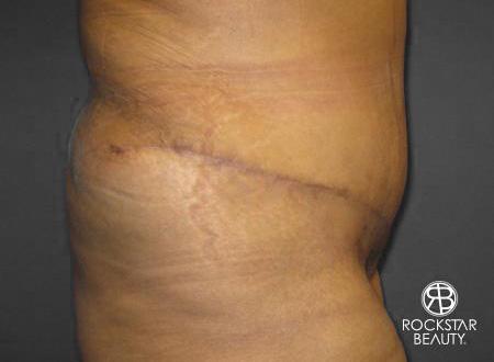 Tummy Tuck: Patient 8 - After 2
