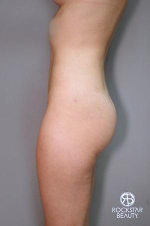 Liposuction: Patient 9 - After 3