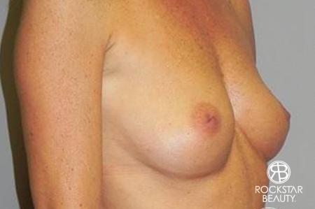 Breast Augmentation: Patient 5 - Before 2