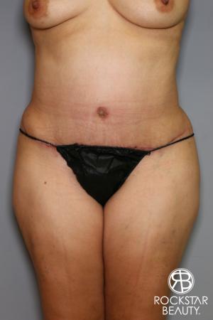 Tummy Tuck: Patient 13 - After Image 1