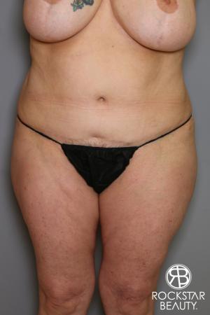 Tummy Tuck: Patient 12 - After Image 1