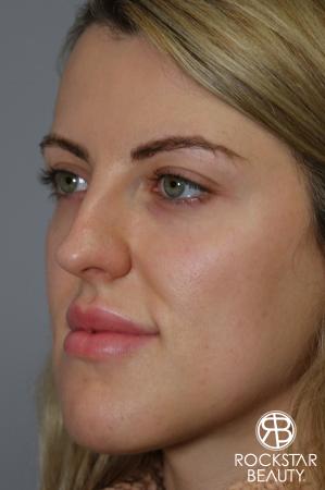 Rhinoplasty: Patient 1 - Before Image 4