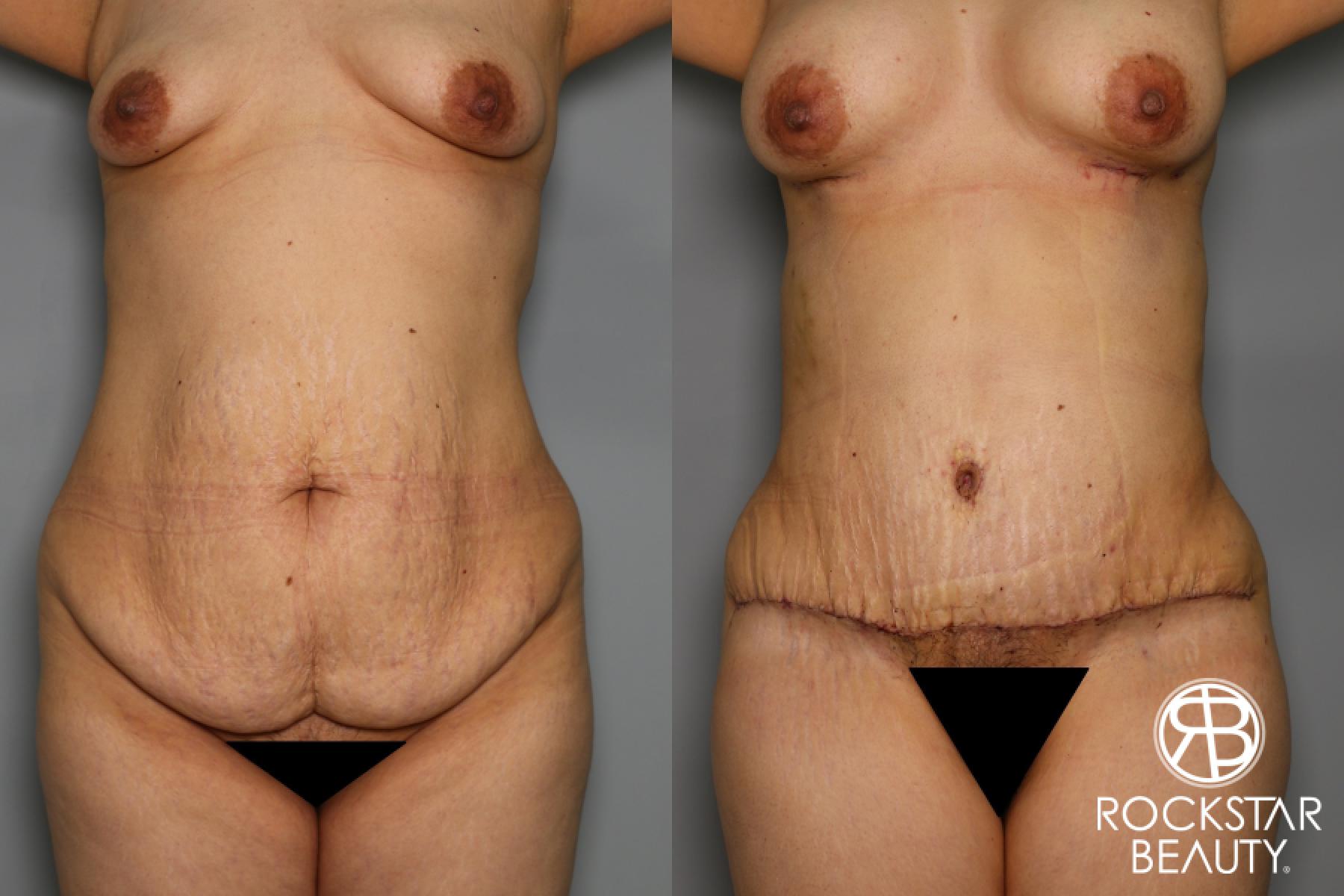 Tummy Tuck: Patient 21 - Before and After 1