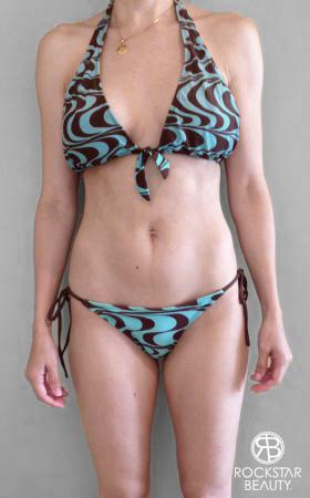 Liposuction: Patient 8 - After 1