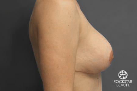 Breast Implant Exchange: Patient 2 - After 2