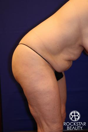 Tummy Tuck: Patient 12 - Before and After Image 5