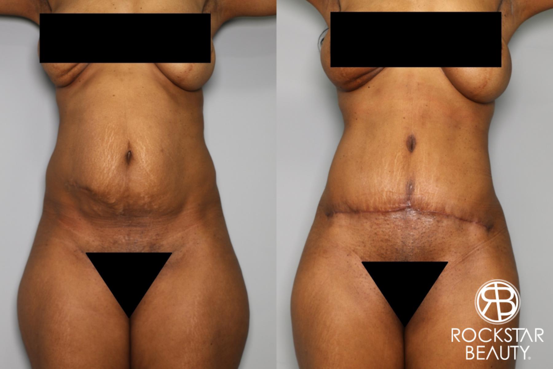 Tummy Tuck: Patient 19 - Before and After 1