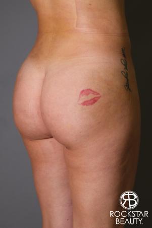 Brazilian Butt Lift: Patient 17 - After Image 2