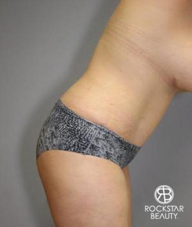 Tummy Tuck: Patient 10 - After Image 4