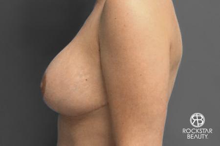 Breast Implant Exchange: Patient 2 - After 3