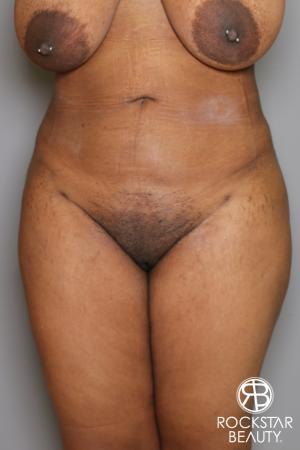 Brazilian Butt Lift: Patient 13 - After Image 4