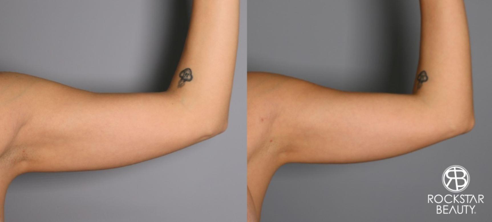 Liposuction: Patient 24 - Before and After 1