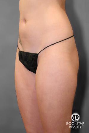 Liposuction: Patient 9 - Before 2