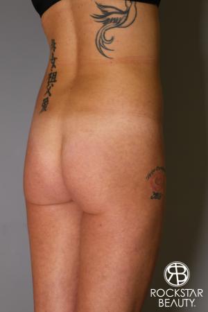 Brazilian Butt Lift: Patient 6 - Before Image 2