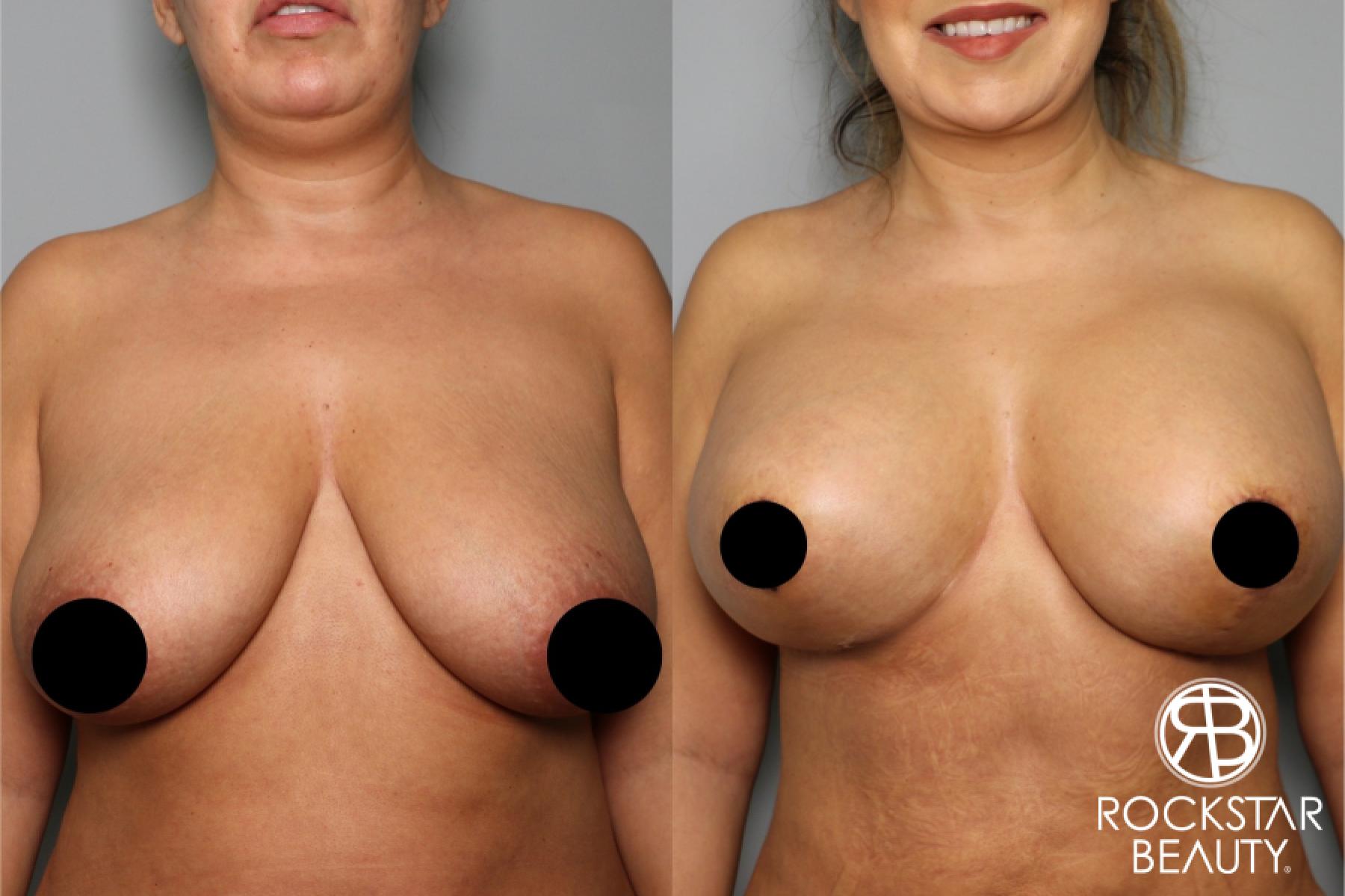 Breast Lift: Patient 7 - Before and After 1