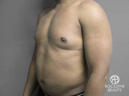 Liposuction: Patient 10 - After 4