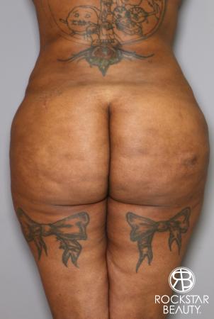 Brazilian Butt Lift: Patient 15 - Before Image 1