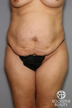 Tummy Tuck: Patient 13 - Before Image 1