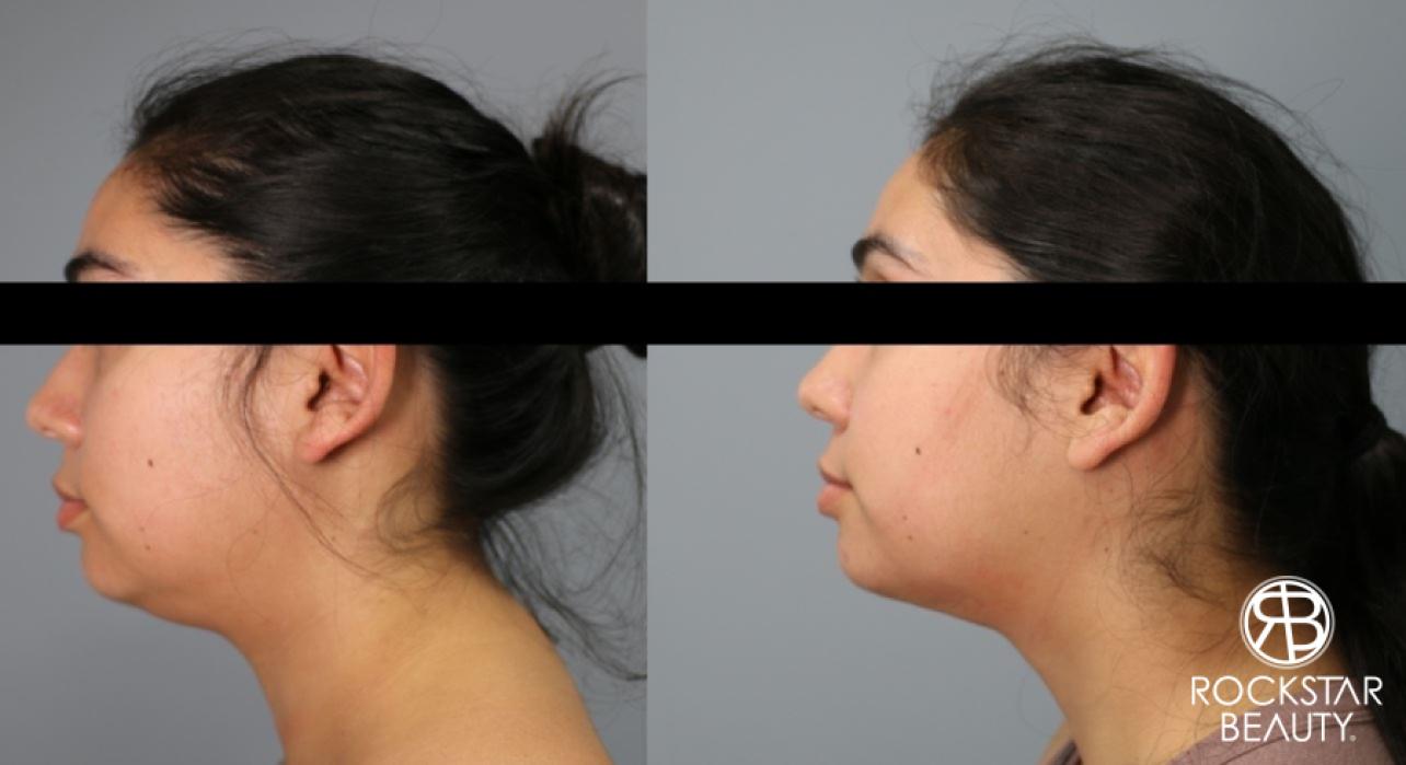 Liposuction Of The Neck: Patient 74 - Before and After 1