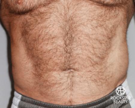 SmartLipo®: Patient 2 - After 1