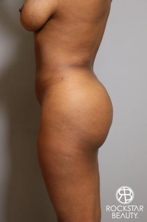 Liposuction: Patient 18 - After Image 4