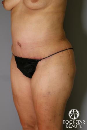 Tummy Tuck: Patient 13 - After Image 3