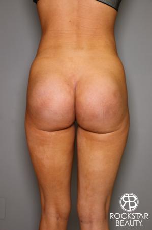 Butt Augmentation: Patient 3 - After Image 1