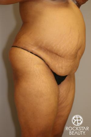Tummy Tuck: Patient 3 - Before Image 2