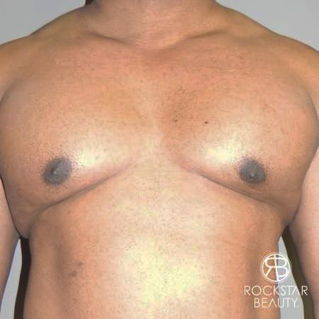Gynecomastia: Patient 1 - Before 1