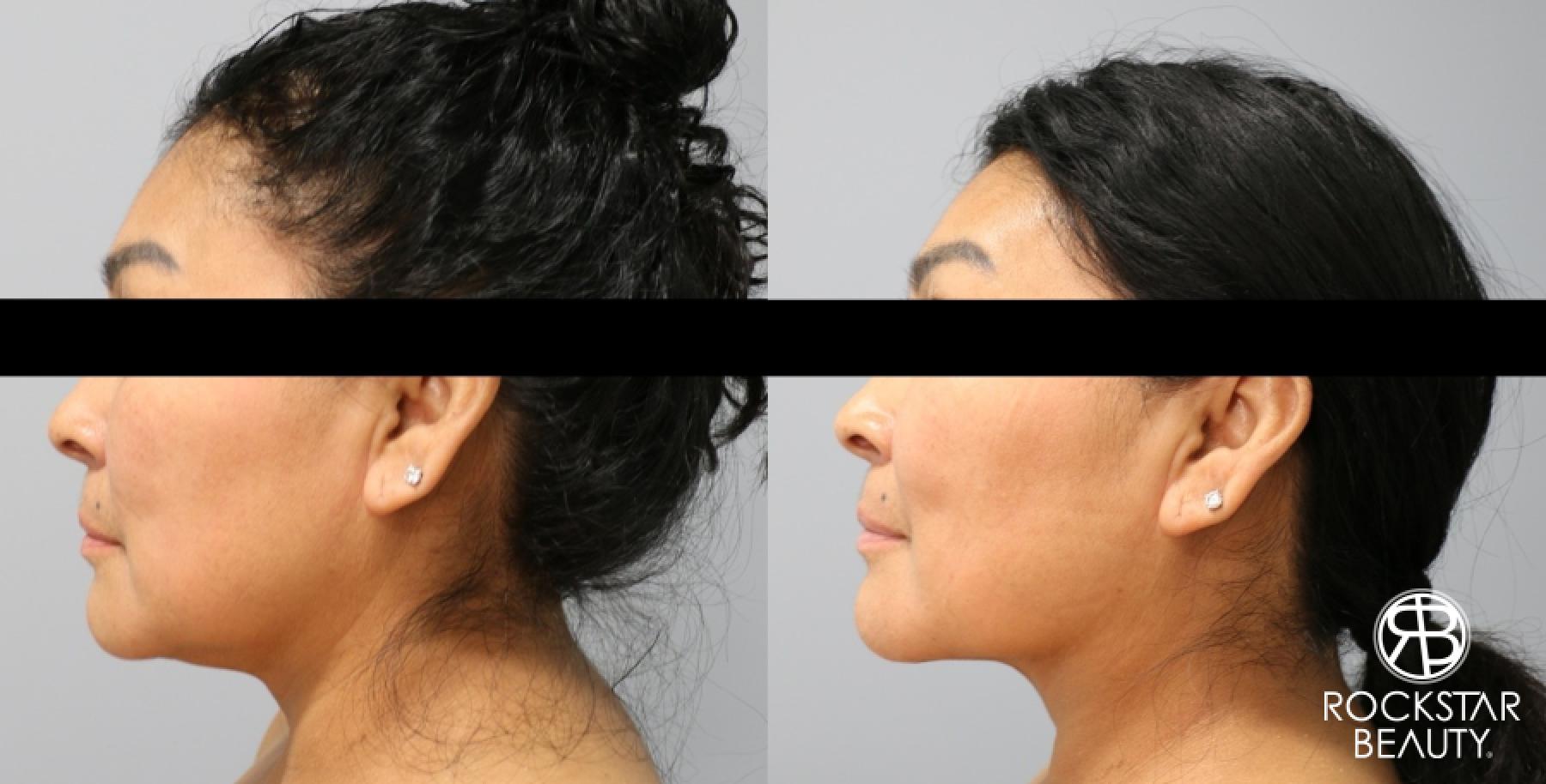 Liposuction Of The Neck: Patient 17 - Before and After 1