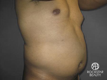 Liposuction: Patient 10 - Before 2