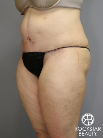 Tummy Tuck: Patient 4 - After Image 4