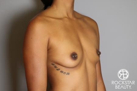 Breast Augmentation: Patient 14 - Before Image 2