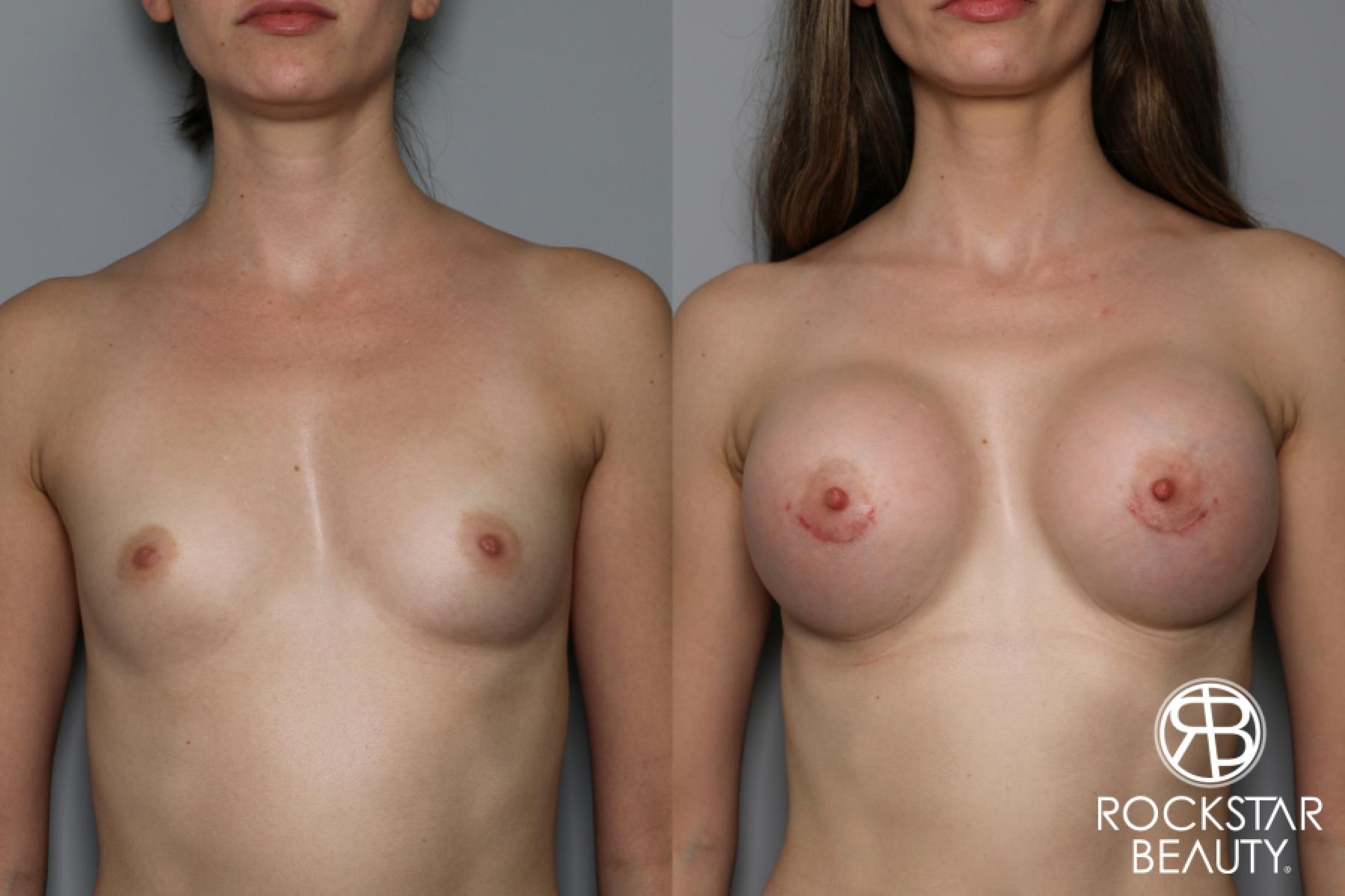 Breast Augmentation: Patient 11 - Before and After 1