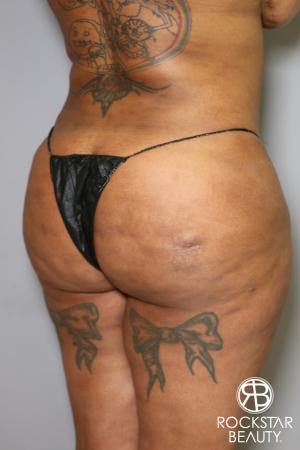 Brazilian Butt Lift: Patient 15 - Before Image 2